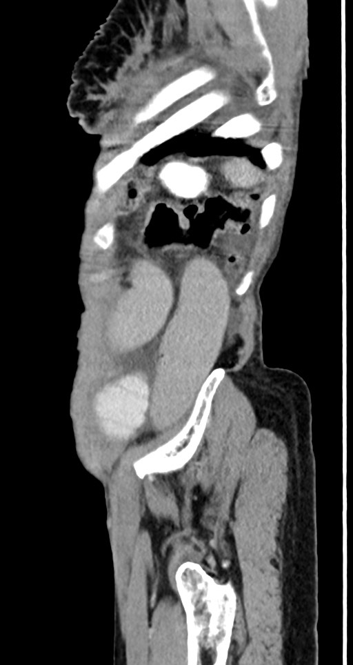 Acute small bowel (ileal) volvulus (Radiopaedia 71740-82139 Sagittal C+ portal venous phase 32).jpg