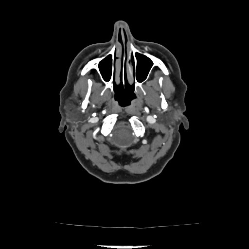 Acute subarachnoid hemorrhage and accessory anterior cerebral artery (Radiopaedia 69231-79009 Axial C+ arterial phase 73).jpg