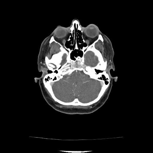Acute subarachnoid hemorrhage and accessory anterior cerebral artery (Radiopaedia 69231-79009 Axial C+ arterial phase 82).jpg