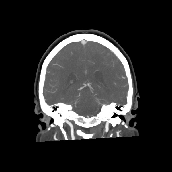 Acute subarachnoid hemorrhage and accessory anterior cerebral artery (Radiopaedia 69231-79009 Coronal C+ arterial phase 52).jpg