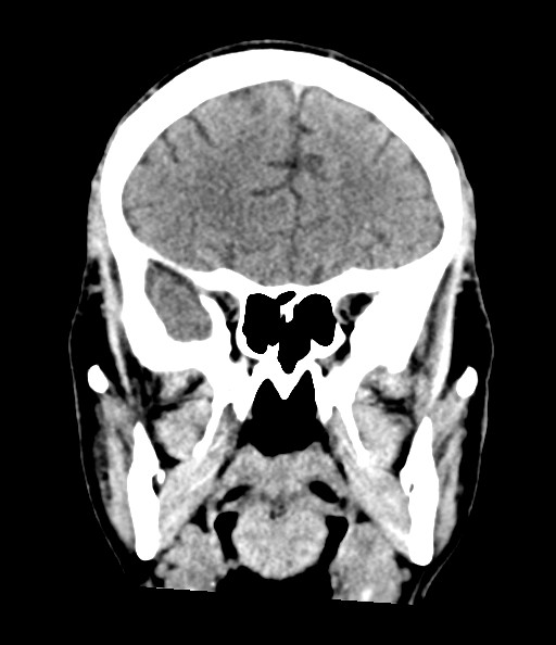 File:Acute superior cerebellar artery territory infarct (Radiopaedia 84104-99359 Coronal non-contrast 36).jpg
