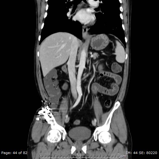 Acute superior mesenteric artery occlusion (Radiopaedia 43636-47060 Coronal C+ portal venous phase 29).jpg