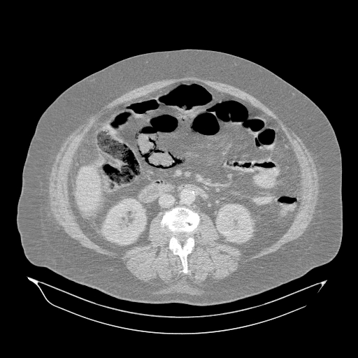 Acute superior mesenteric artery occlusion (Radiopaedia 51288-56960 Axial lung window 29).jpg