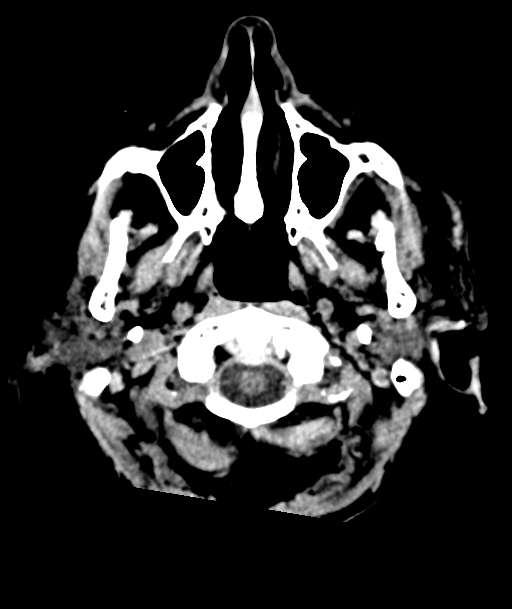Acute traumatic subdural hematoma (Radiopaedia 82921-97257 Axial non-contrast 61).jpg