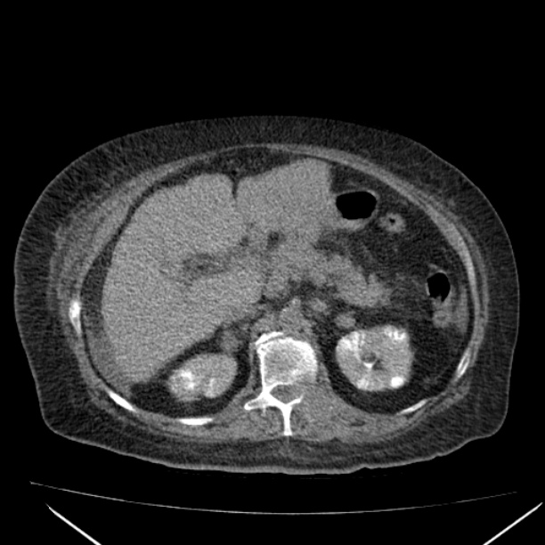 Acute tubular necrosis (Radiopaedia 28077-28334 Axial non-contrast 25).jpg