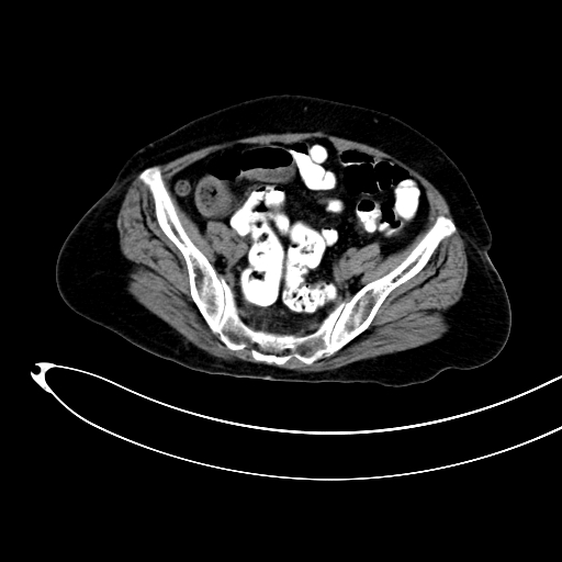 Adenocarcinoma colon with intussusception (Radiopaedia 86006-101922 Axial non-contrast 47).jpg