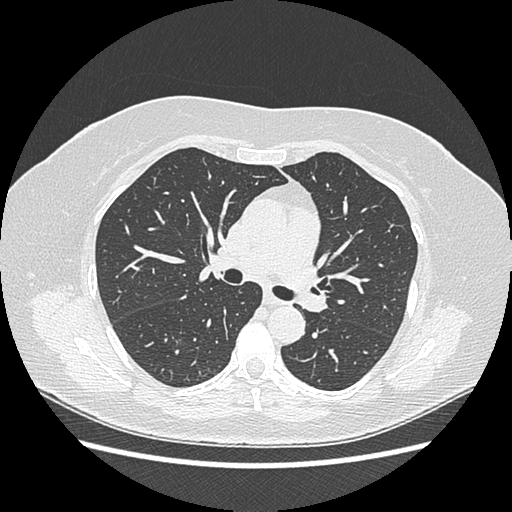 Adenocarcinoma in situ of lung (Radiopaedia 38685-40829 B 99).png