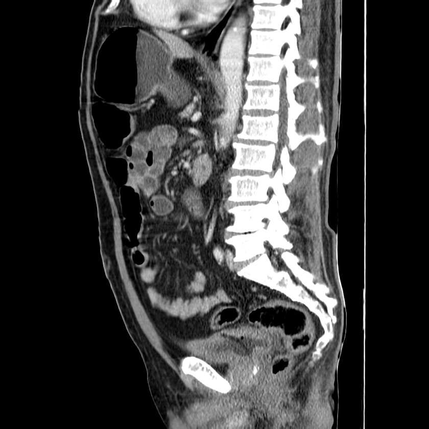 Adenocarcinoma of colon with entero-colic fistula (Radiopaedia 22832-22852 Sagittal C+ portal venous phase 36).jpg