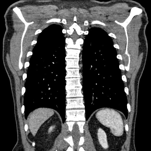 Adenocarcinoma of the lung (Radiopaedia 59871-67325 Coronal C+ arterial phase 56).jpg