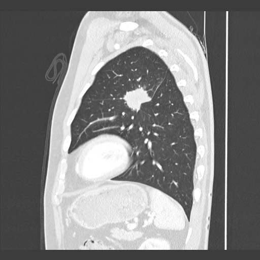 Adenocarcinoma of the lung (Radiopaedia 59871-67325 Sagittal lung window 78).jpg