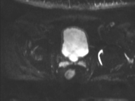 Adenocarcioma of rectum- T1 lesion (Radiopaedia 36921-38546 Axial DWI 13).png