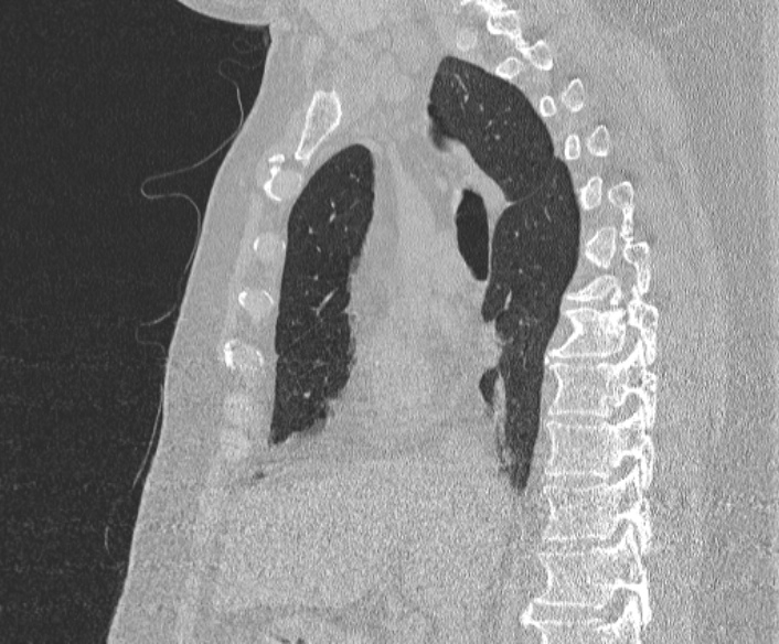 Adenoid cystic carcinoma of the trachea (Radiopaedia 49042-54137 Sagittal lung window 210).jpg