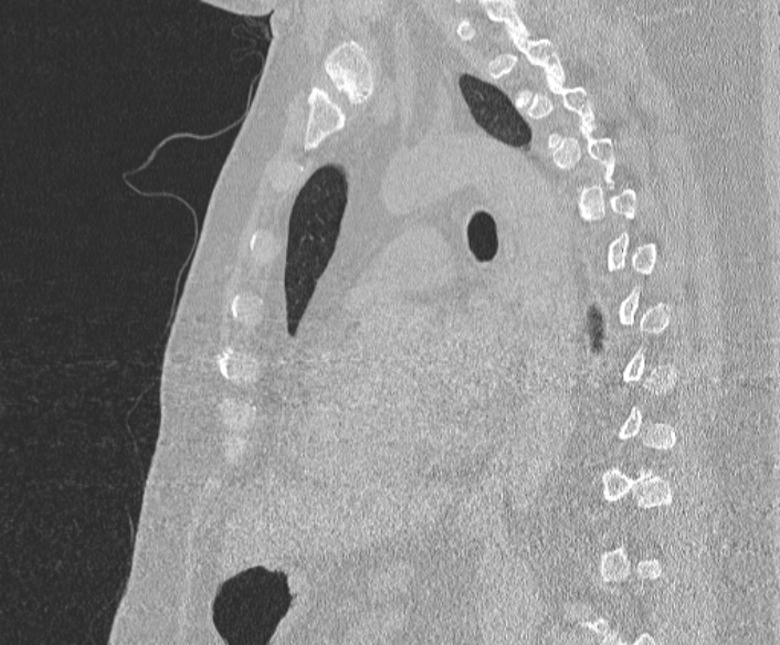 Adenoid cystic carcinoma of the trachea (Radiopaedia 49042-54137 Sagittal lung window 266).jpg