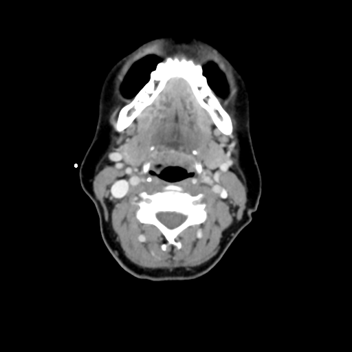 File:Adenoid cystic tumor of palate (Radiopaedia 46980-51518 Axial C+ delayed 41).png