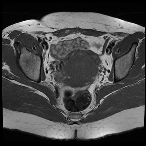 File:Adenomyosis-scar endometriosis (Radiopaedia 65863-75022 Axial T1 18).jpg