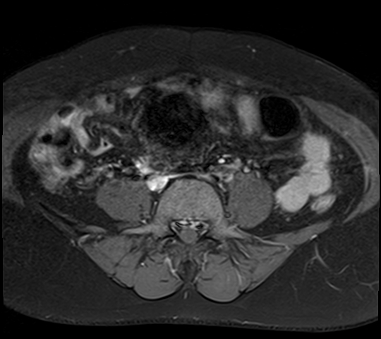 File:Adenomyosis - ovarian endometriomas (Radiopaedia 67031-76350 Axial T1 C+ fat sat 3).jpg