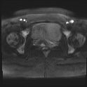 File:Adenomyosis and endometriotic cysts (Radiopaedia 82300-96367 Axial DWI 23).jpg