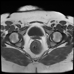 File:Adenomyosis within a didelphys uterus (Radiopaedia 70175-80215 Axial T1 33).jpg