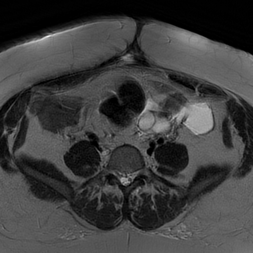 File:Adenomyosis within a didelphys uterus (Radiopaedia 70175-80215 Axial T2 5).jpg