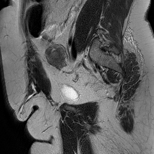 File:Adenomyosis within a didelphys uterus (Radiopaedia 70175-80215 Sagittal T2 10).jpg