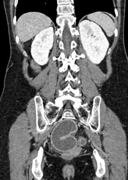 Adhesional small bowel obstruction (Radiopaedia 48397-53305 Coronal C+ portal venous phase 266).jpg