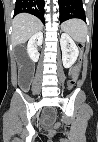 File:Adhesional small bowel obstruction (Radiopaedia 52107-57980 Coronal C+ portal venous phase 57).jpg