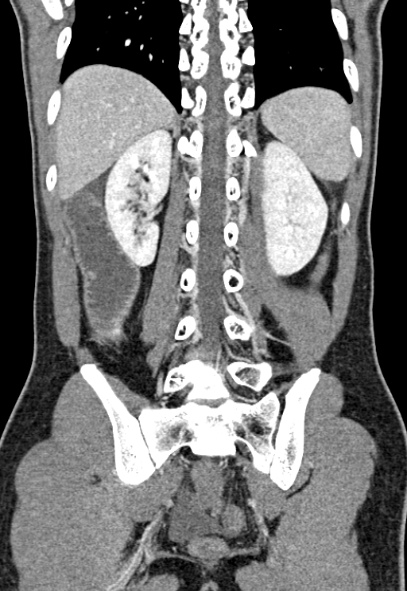 Adhesional small bowel obstruction (Radiopaedia 52107-57980 Coronal C+ portal venous phase 61).jpg