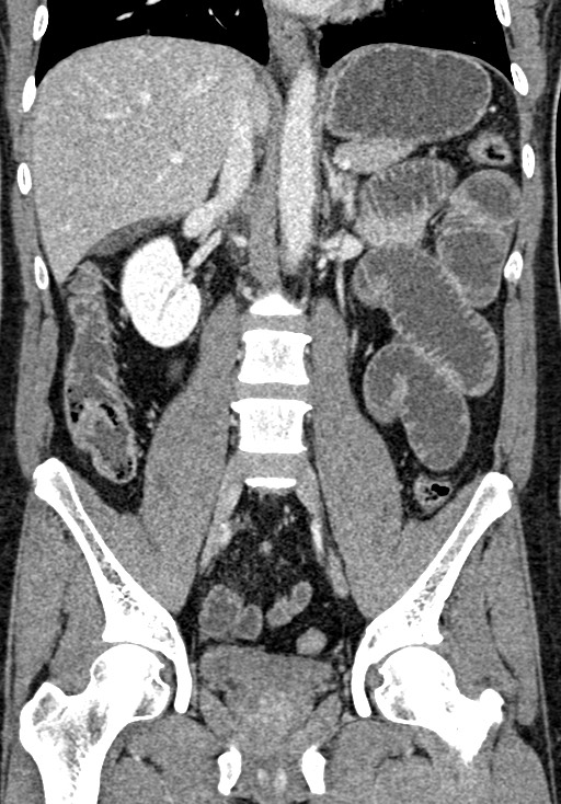 Adhesional small bowel obstruction (Radiopaedia 58900-66131 Coronal C+ portal venous phase 152).jpg