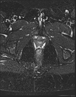 File:Adnexal multilocular cyst (O-RADS US 3- O-RADS MRI 3) (Radiopaedia 87426-103754 Axial T2 fat sat 24).jpg