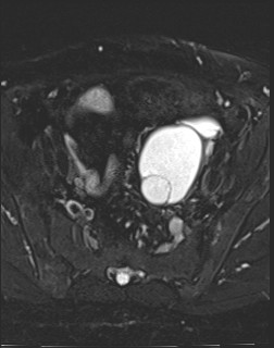 File:Adnexal multilocular cyst (O-RADS US 3- O-RADS MRI 3) (Radiopaedia 87426-103754 Axial T2 fat sat 8).jpg