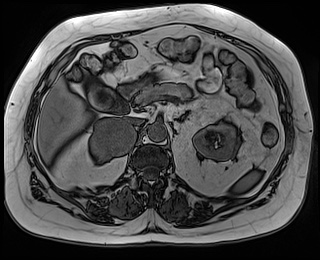 File:Adrenal cortical carcinoma (Radiopaedia 64017-72770 Axial T1 out-of-phase 31).jpg