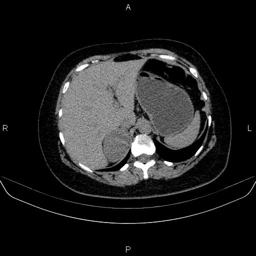 File:Adrenal cortical carcinoma (Radiopaedia 84882-100379 Axial non-contrast 19).jpg