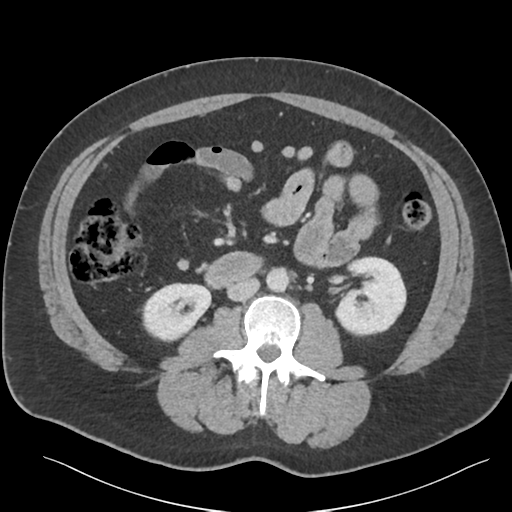 Adrenal cyst (Radiopaedia 45625-49777 Axial C+ portal venous phase 52).png