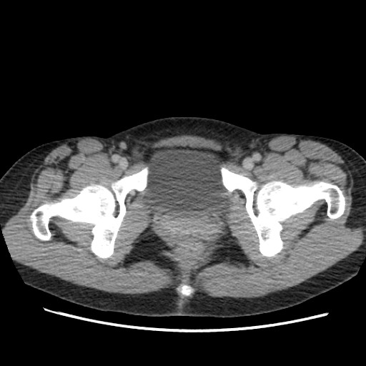 Adrenal cyst (Radiopaedia 64869-73813 Axial C+ portal venous phase 78).jpg