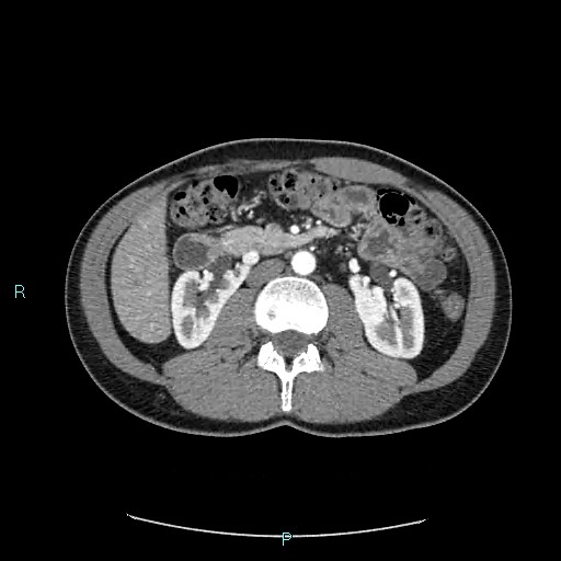 Adrenal cystic lymphangioma (Radiopaedia 83161-97534 Axial C+ arterial phase 43).jpg
