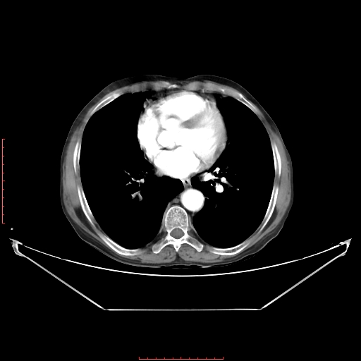 Adrenal hemangioma (Radiopaedia 68923-78668 Axial C+ arterial phase 5).jpg