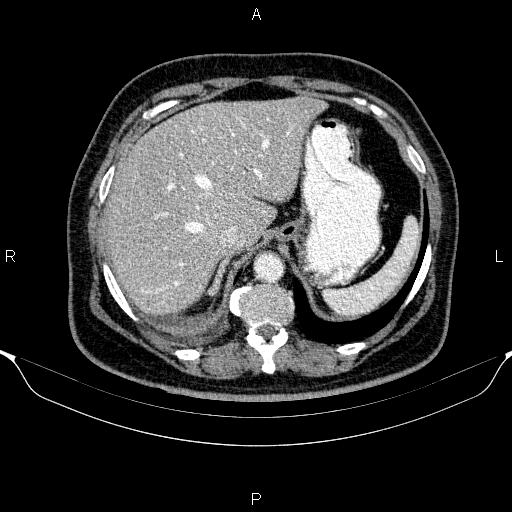 Adrenal hemorrhage (Radiopaedia 62622-70916 Axial C+ portal venous phase 30).jpg