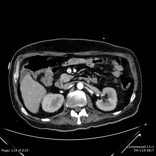 Adrenal metastasis (Radiopaedia 78425-91079 Axial C+ arterial phase 45).jpg