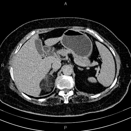 Adrenal myelolipoma (Radiopaedia 82742-96986 Axial renal excretory phase 34).jpg