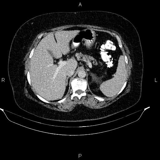 File:Adrenal myelolipoma (Radiopaedia 84319-99617 Axial renal cortical phase 33).jpg