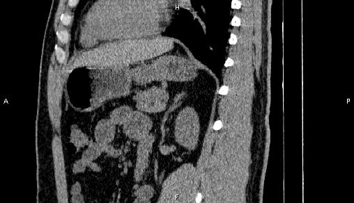 Adrenal myelolipoma (Radiopaedia 84321-99619 Sagittal non-contrast 69).jpg