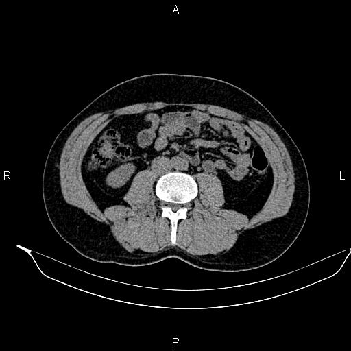 Adrenal myelolipoma (Radiopaedia 87794-104246 Axial non-contrast 58).jpg