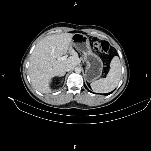 Adrenal myelolipoma (Radiopaedia 87794-104246 Axial renal cortical phase 24).jpg