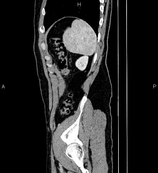 Adrenal myelolipoma (Radiopaedia 87794-104246 Sagittal renal cortical phase 82).jpg