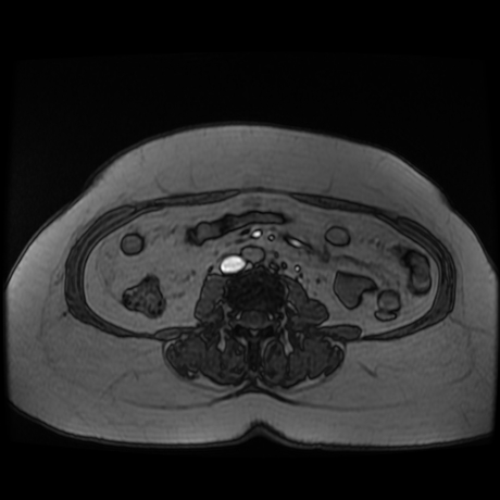 File:Adrenal myelolipoma - MRI (Radiopaedia 83249-97646 T1 out-of-phase 24).jpg