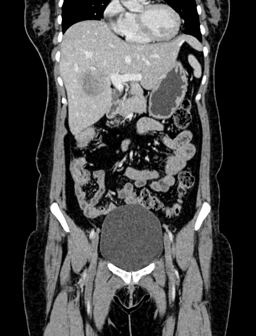 Adrenocortical carcinoma (Radiopaedia 87281-103569 Coronal C+ portal venous phase 6).jpg