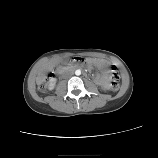 Adult polycystic kidney disease (Radiopaedia 48845-53876 Axial renal cortical phase 34).jpg