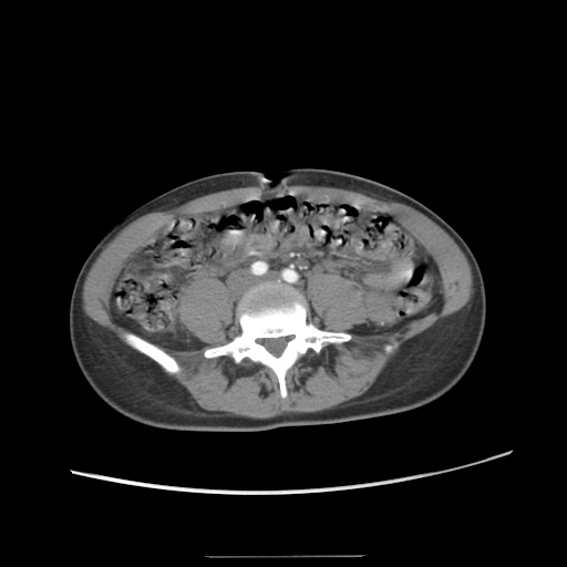 Adult polycystic kidney disease (Radiopaedia 48845-53876 Axial renal cortical phase 48).jpg