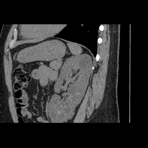 Adult polycystic kidney disease (Radiopaedia 59075-66368 Sagittal non-contrast 63).jpg