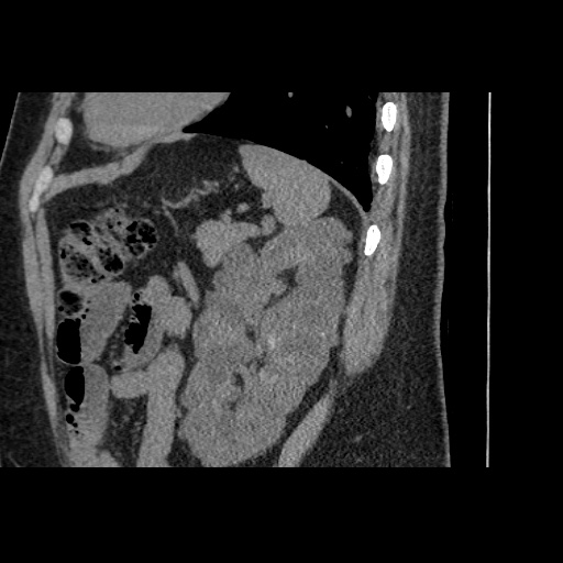 Adult polycystic kidney disease (Radiopaedia 59075-66368 Sagittal non-contrast 69).jpg